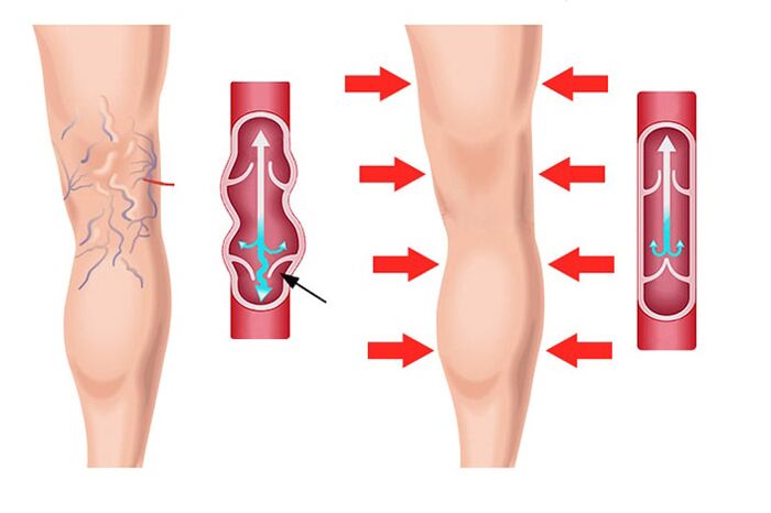 Effekt vum Levicose Gel an der Behandlung