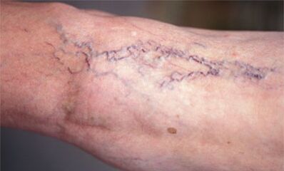 Methode vun der Behandlung vun Krampfadern op de Been