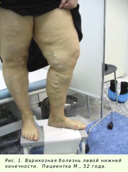 Krampfadern musse behandelt ginn fir de Prozess ze stoppen