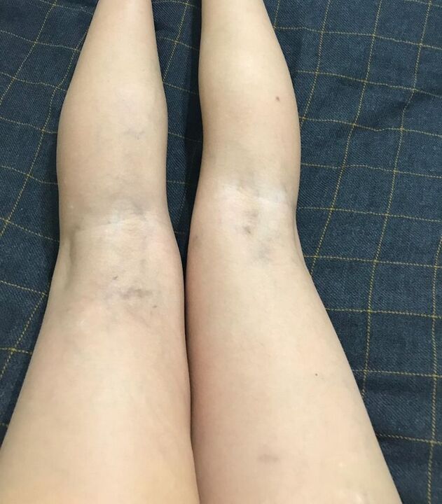 Manifestatiounen vun Krampfadern op de Been