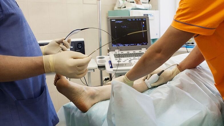 Chirurgie fir Krampfadern ze entfernen