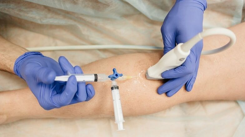 Sklerotherapie fir Krampfadern