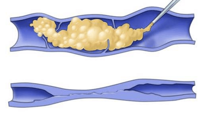 Sklerotherapie fir Krampfadern